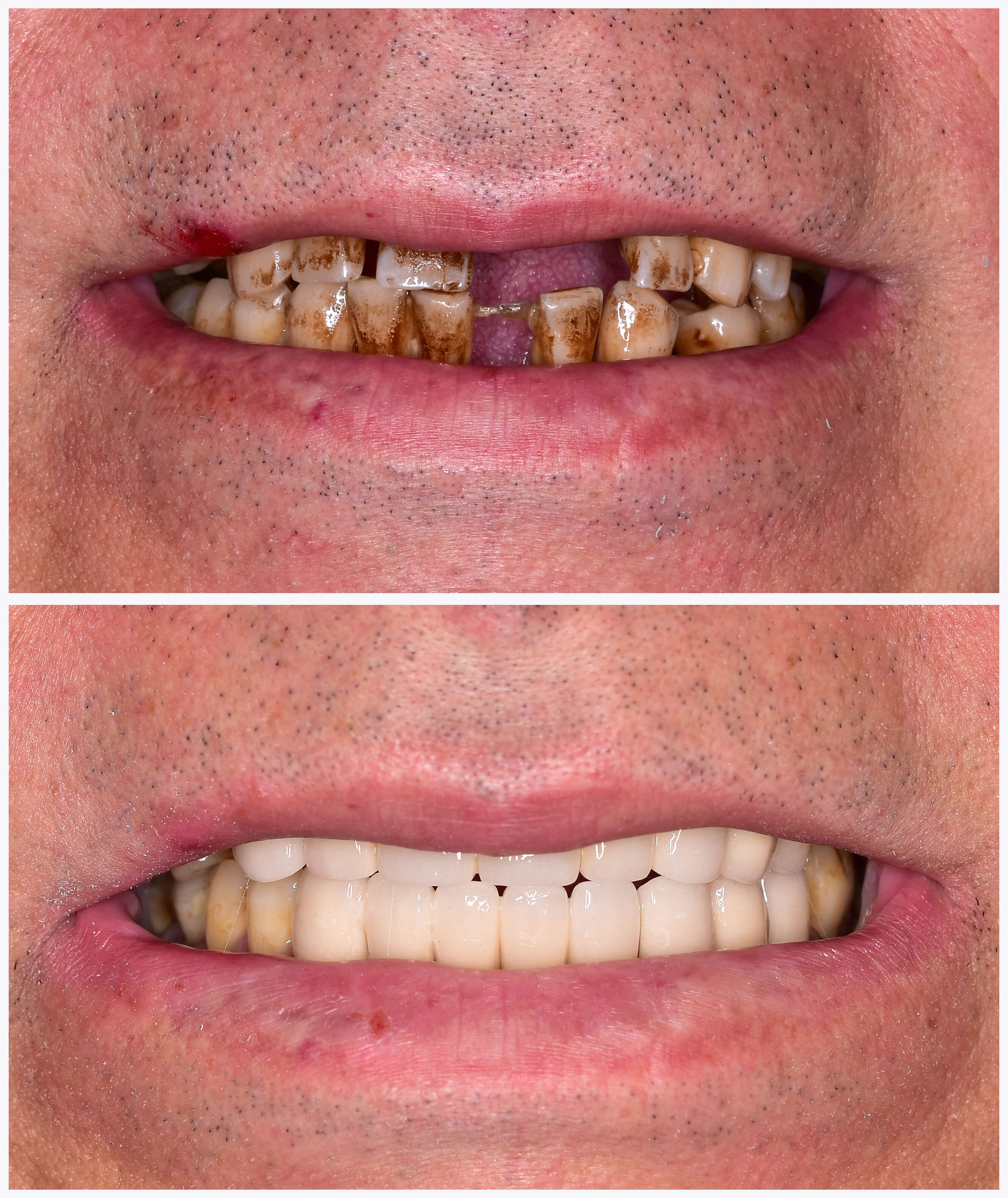 Implant treatment fo missing teeth and brighter smile. Before and after photo of a patien with a severely colored and damaged teeth.