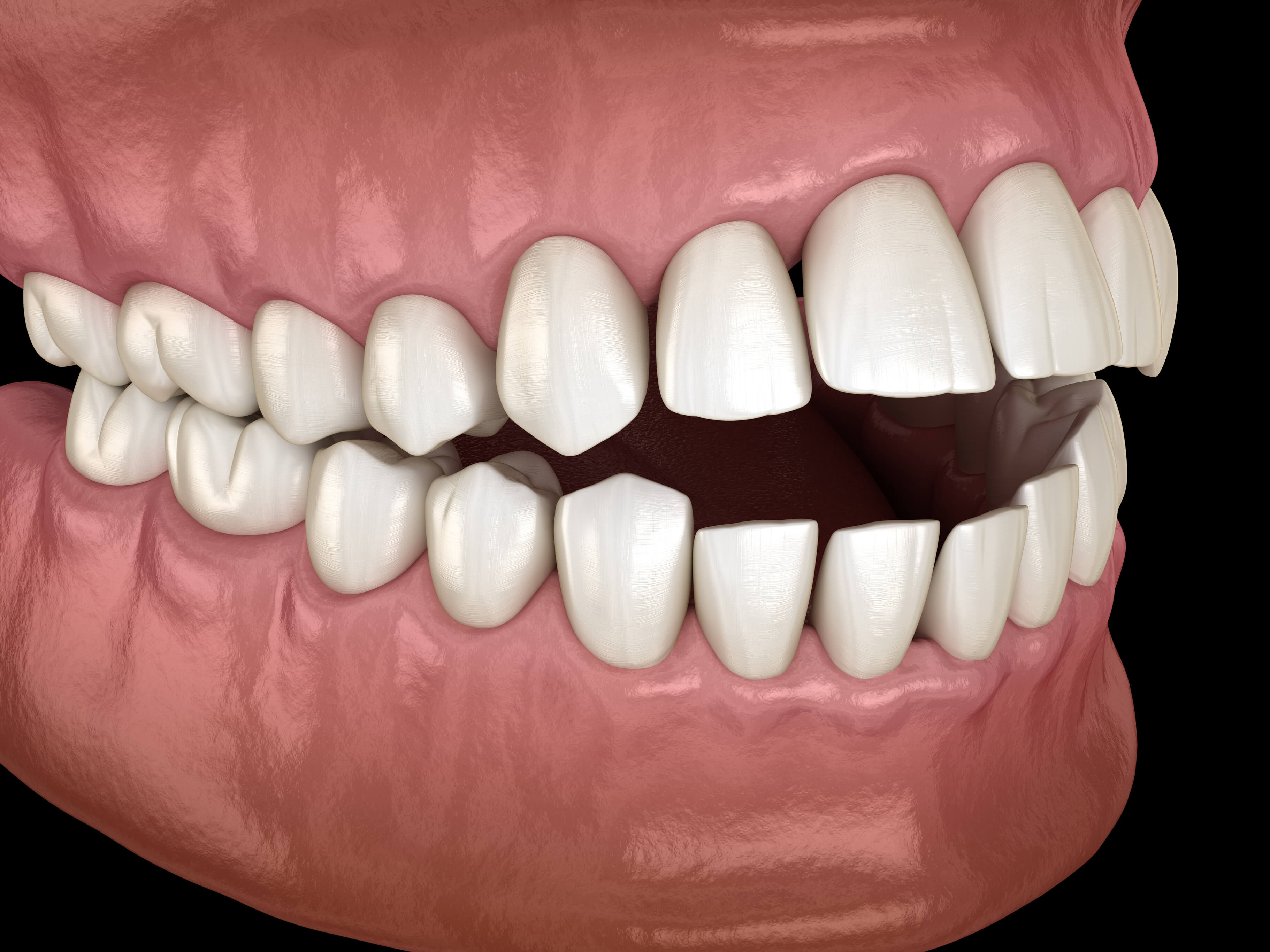 Openbite dental occlusion