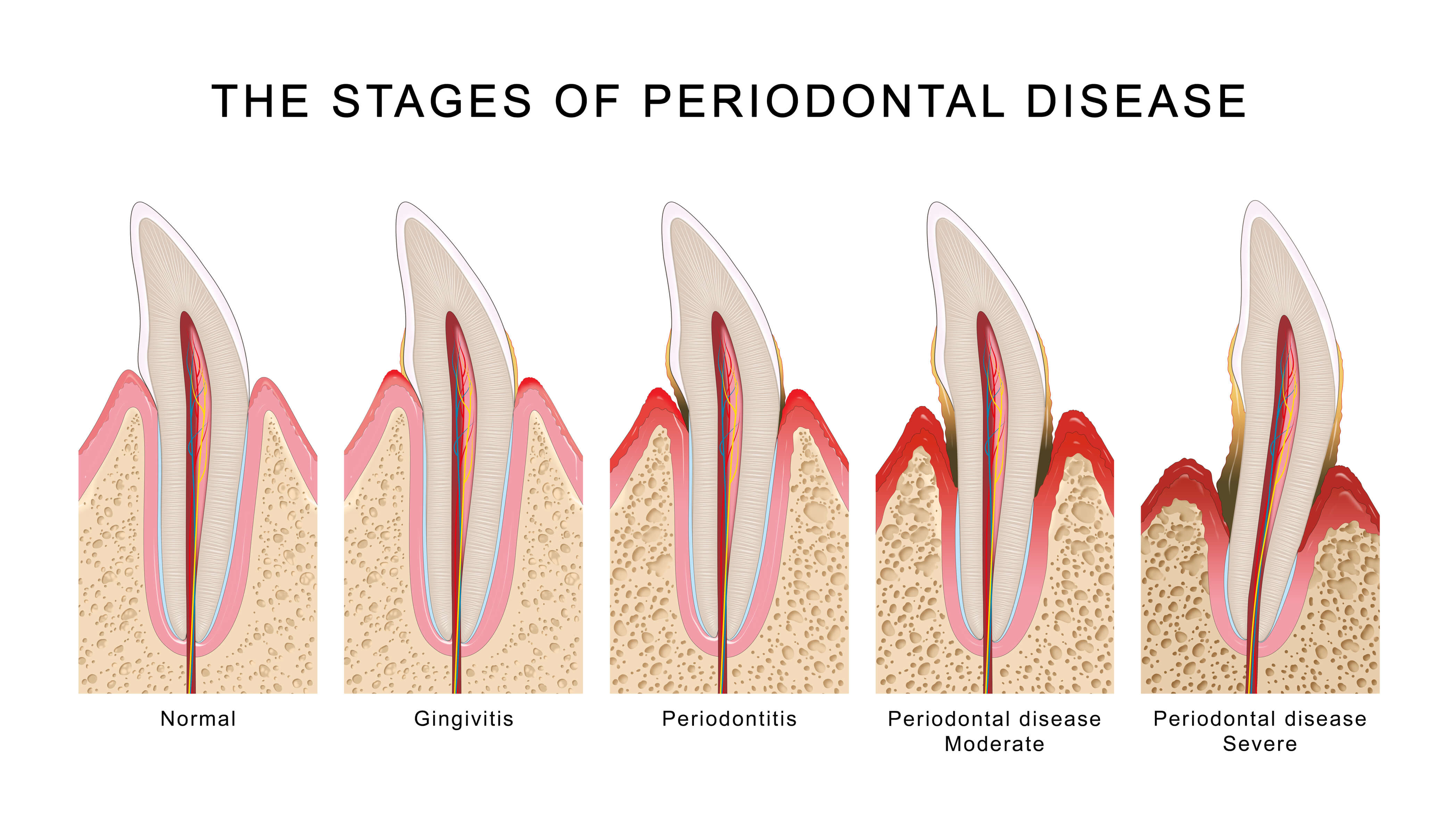 Stage of Periodontal Disease 