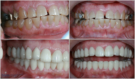 Chipped and stained teeth after a full mouth reconstruction in Mexico