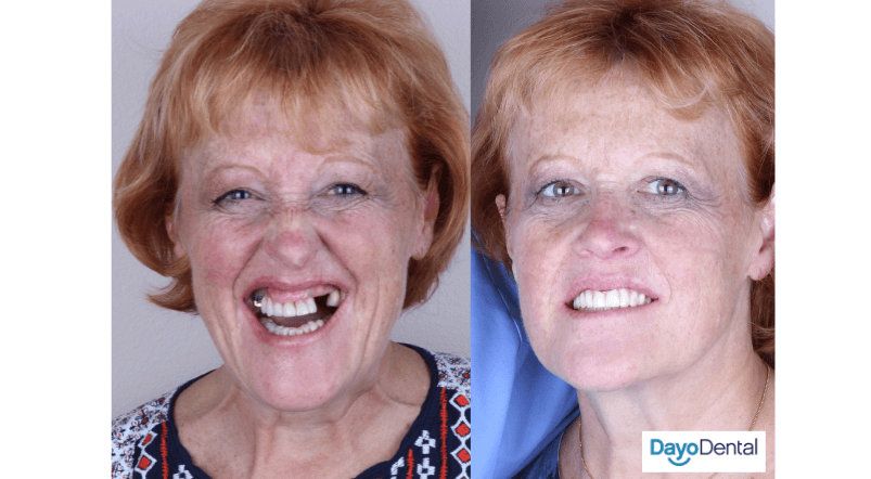 Before and after dental implants by a top dentist in Mexico