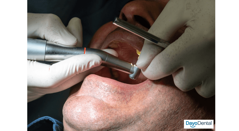 Dental Implants by a top dentist in Los Algodones