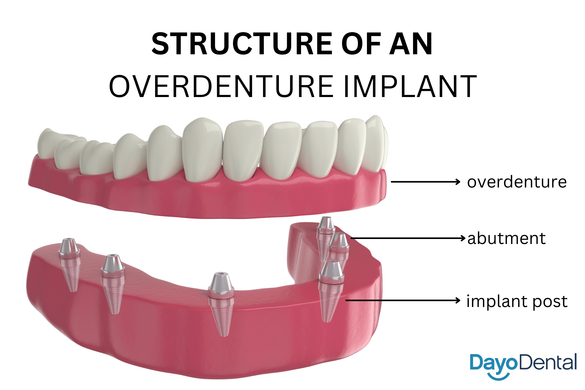 Structure of an overdenture implant