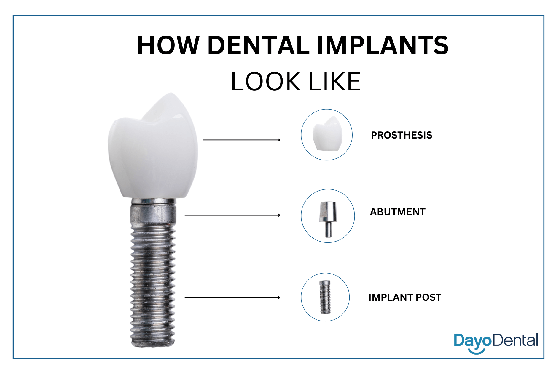 How Dental Implants Look Like