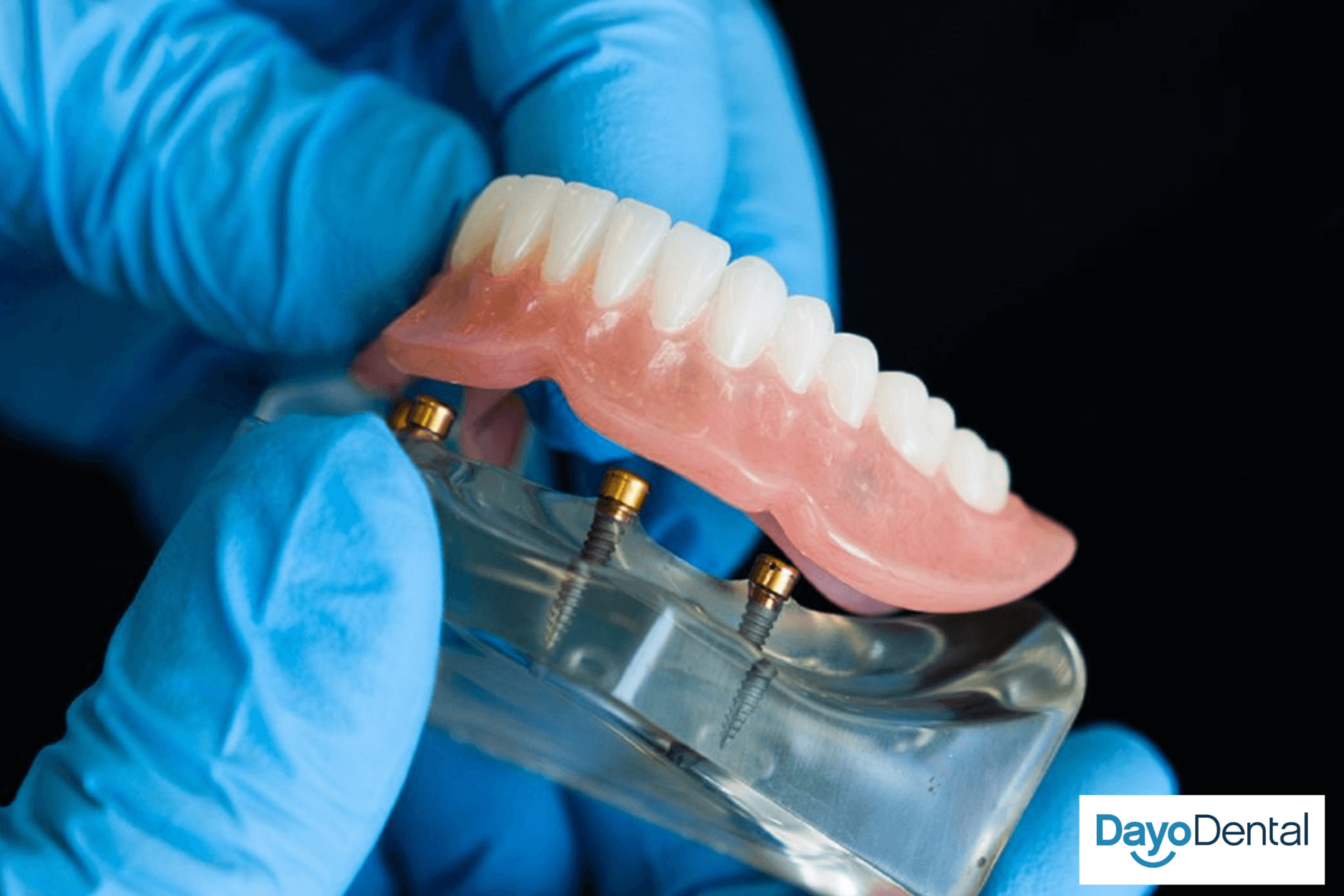 Snap in dentures. Implant-supported dentures. Overdentures in Mexico.