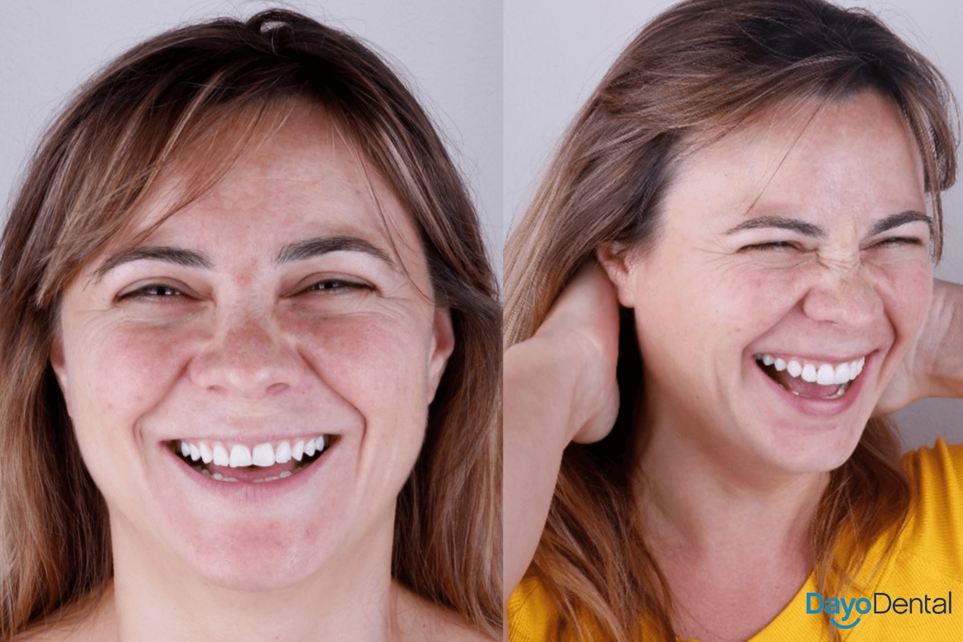 Before and After Ceramic Veneers in mexico