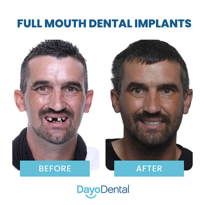 Full Mouth Dental Implants Before and After Dayo Dental
