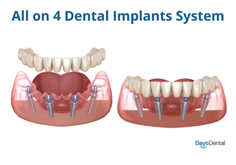 The All on 4 dental implants in Los Algodones