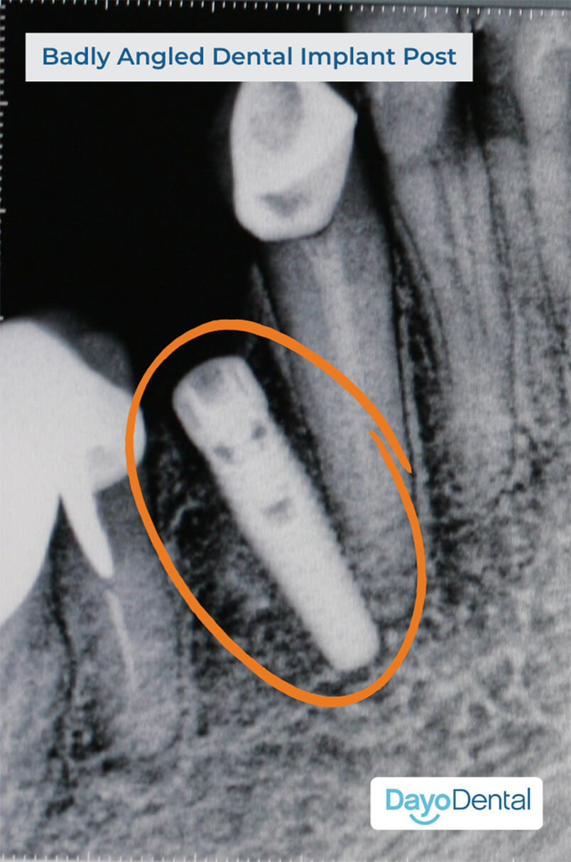 Badly Angled Dental Implant Post