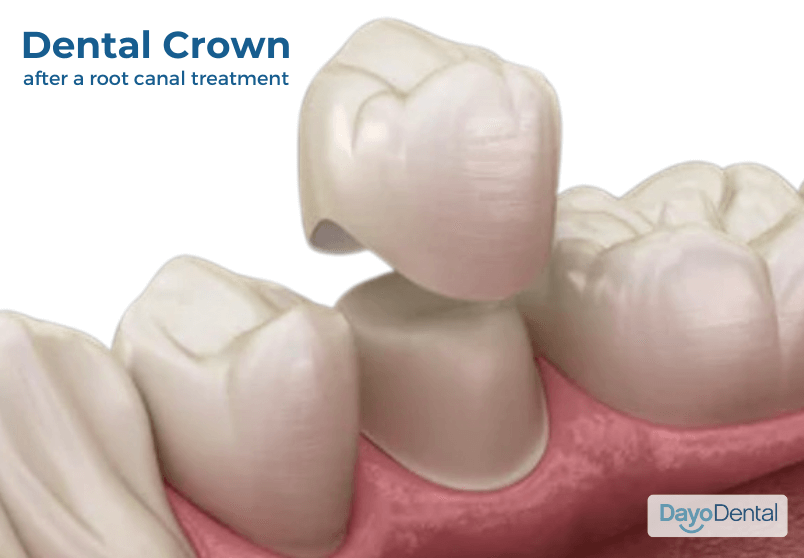 Dental Crown After Root Canal Treatment