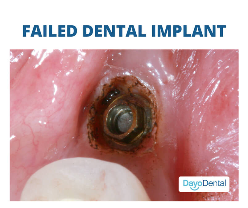 Failed Dental Implant