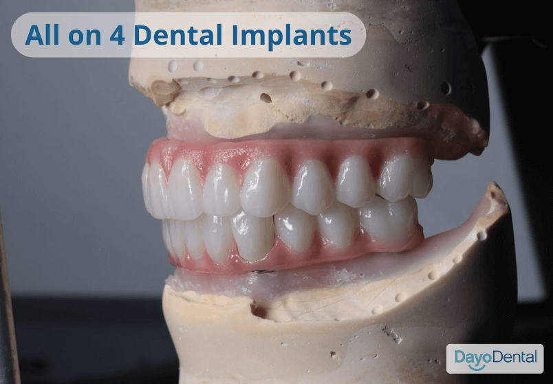 All on 4 Dental Implant in Los Algodones: Pros and Cons That You Need to Know
