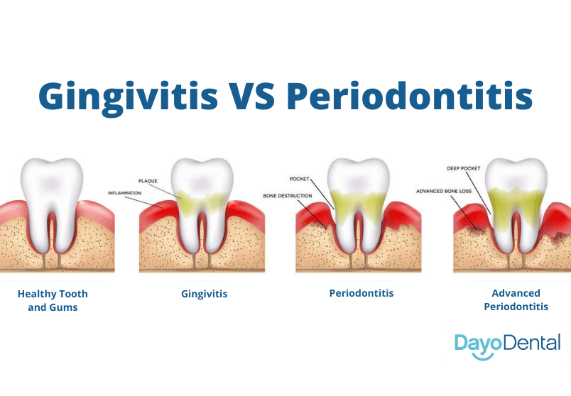 Gingivitis vs Periodontitis: Stages of Gum Diseases Explained Dayo Dental