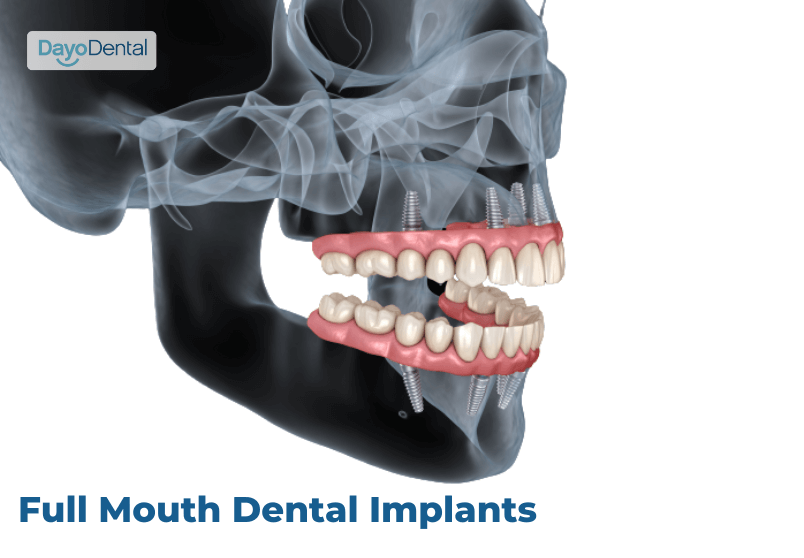 Full Mouth Dental Implants Dayo Dental
