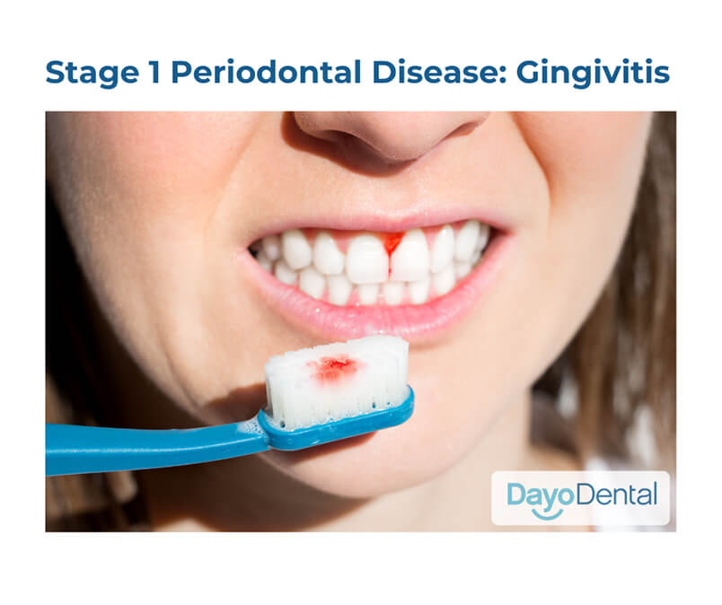 Stage 1 Periodontal Disease Gingivitis