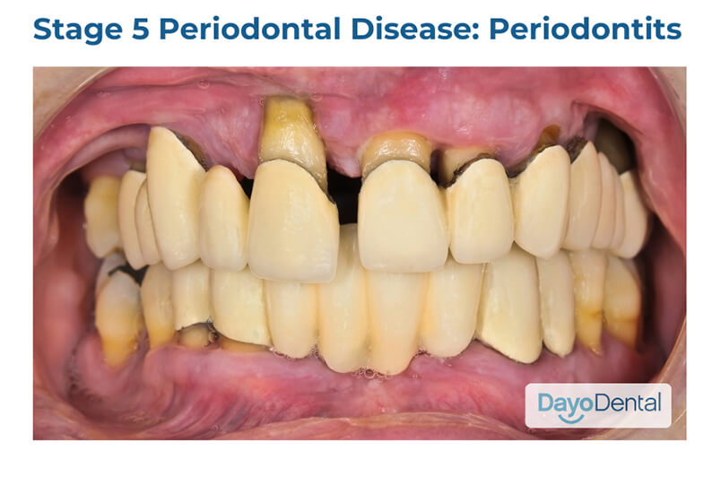 Stage 5 Periodontal Disease Periodontitis