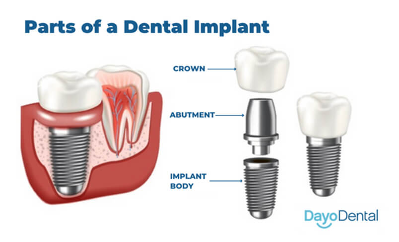 Parts of Dental Implants Dayo Dental
