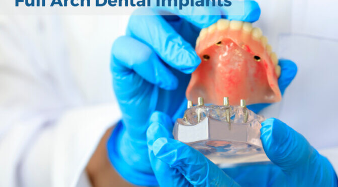Full Arch Dental Implants