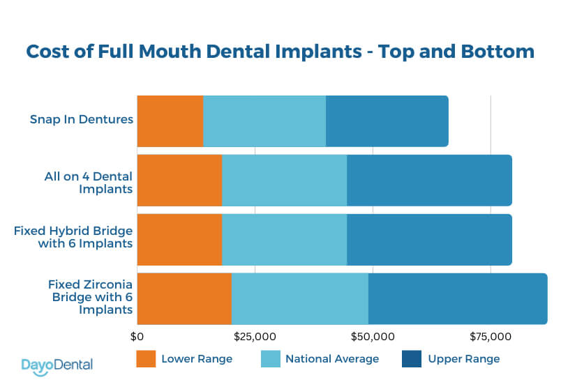 Cost of Full Mouth Dental Implants Top and Bottom